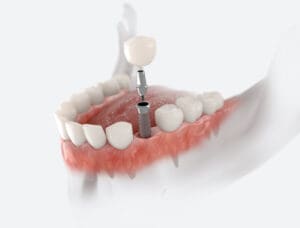 Premolar tooth implant services in Charleston, WV