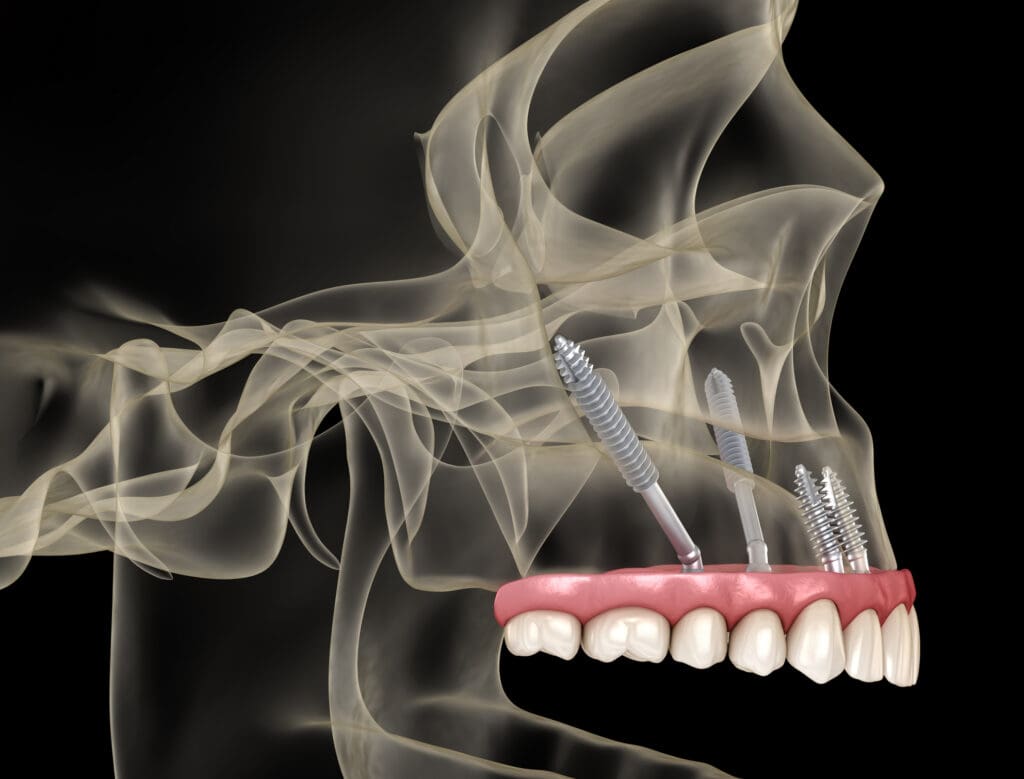 zygomatic dental implants in charleston wv 