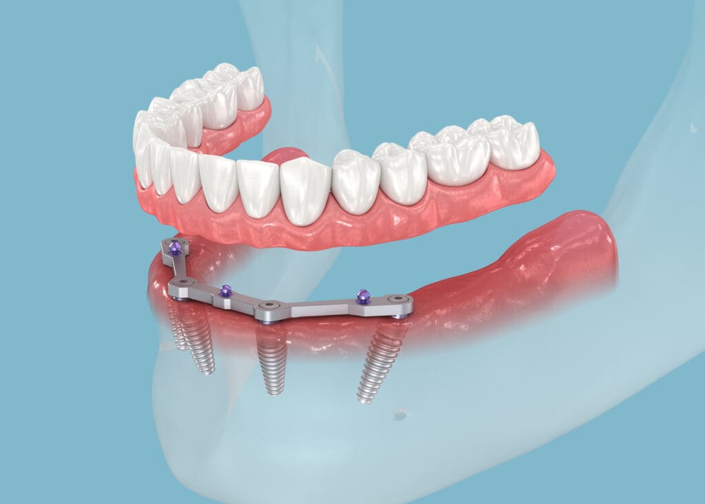trefoil dental implant process in charleston wv 