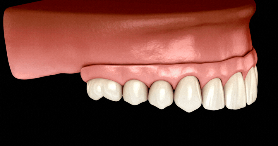 Same Day Dental Implants in Charleston WV