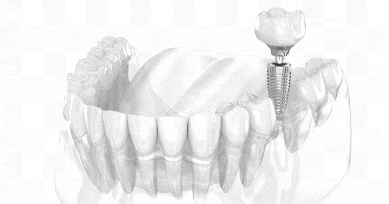 Dental Implants in Charleston, WV