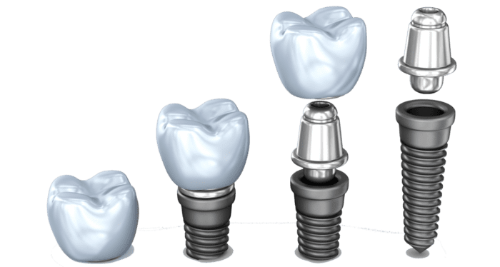 Single Tooth Implants in Charleston, WV