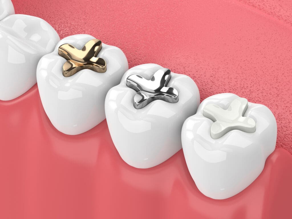 Dental Fillings in Charleston WV