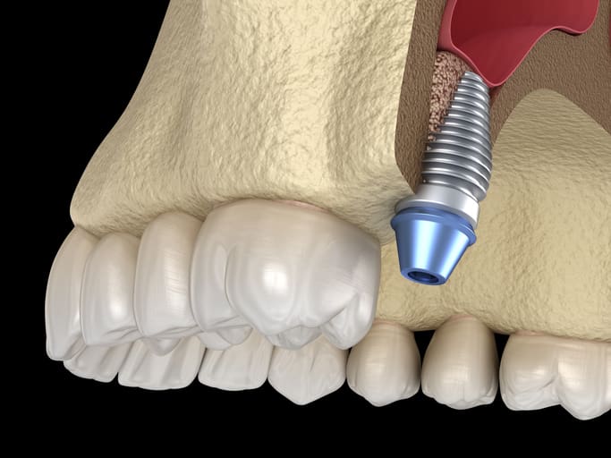 Sinus Lift for Dental Implants