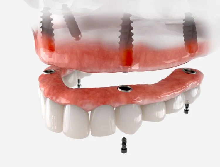 Why Do My Dentures Click and Sore? Solutions in Charleston, WV
